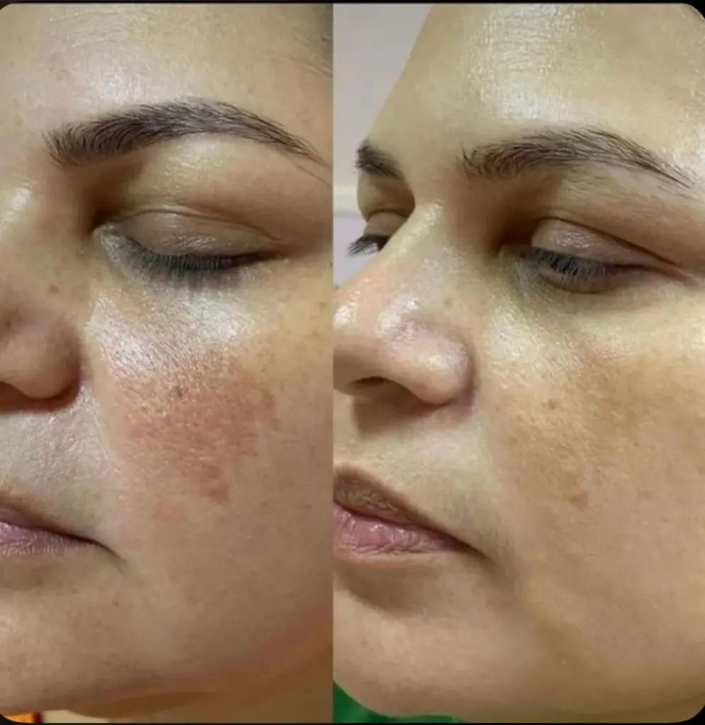 Melaclear Cream (50gm)