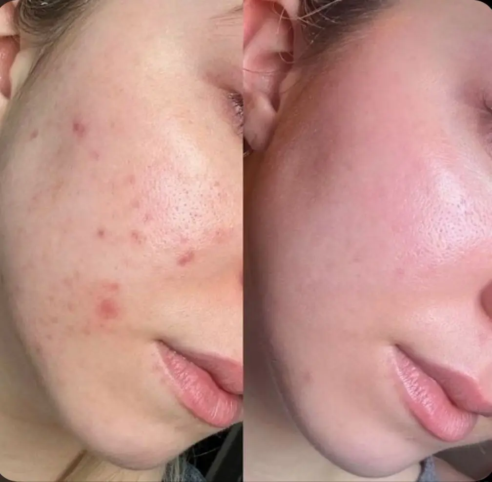 Skin Clear Acne Gel (50gm)